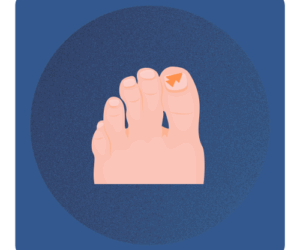 Terapia grzybicy paznokci Warszawa Bielany Ilustracja stopy z zaznaczonymi paznokciami zmienionymi chorobowo – Terapia grzybicy paznokci w gabinecie Na Stopie