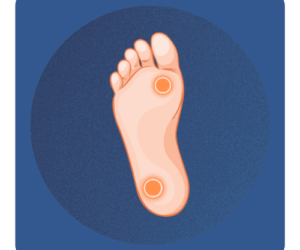 Usuwanie odcisków z rdzeniem Warszawa Ilustracja bolesnego odcisku na stopie z widocznym rdzeniem – Bezbolesne usuwanie nagniotków w gabinecie Na Stopie.