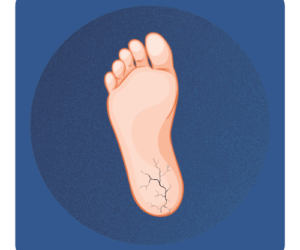 Usuwanie pękających pięt i zrogowaceń Warszawa Na Stopie Podolog Warszawa Bielany pomoze w takim problemie jak pękające pięty