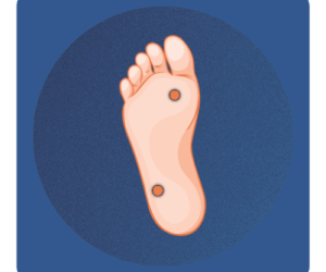 Usuwanie kurzajek i brodawek Warszawa Bielany Ilustracja stopy z zaznaczonymi kurzajkami – Terapia brodawek wirusowych w gabinecie Na Stopie.