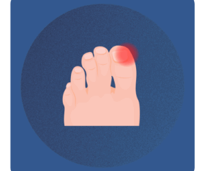 Terapia wrastających paznokci i klamry Warszawa Ilustracja wrastającego paznokcia ze stanem zapalnym – Bezinwazyjna korekcja klamrami w gabinecie Na Stopie.