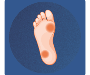 Usuwanie modzeli i zrogowaceń Warszawa Ilustracja stopy z widocznymi modzelami – Pedicure podologiczny i usuwanie zrogowaceń na Bielanach.