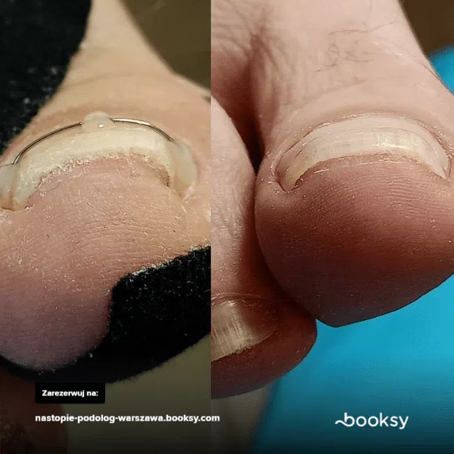 Klamra na wrastający paznokieć - efekty terapii Warszawa