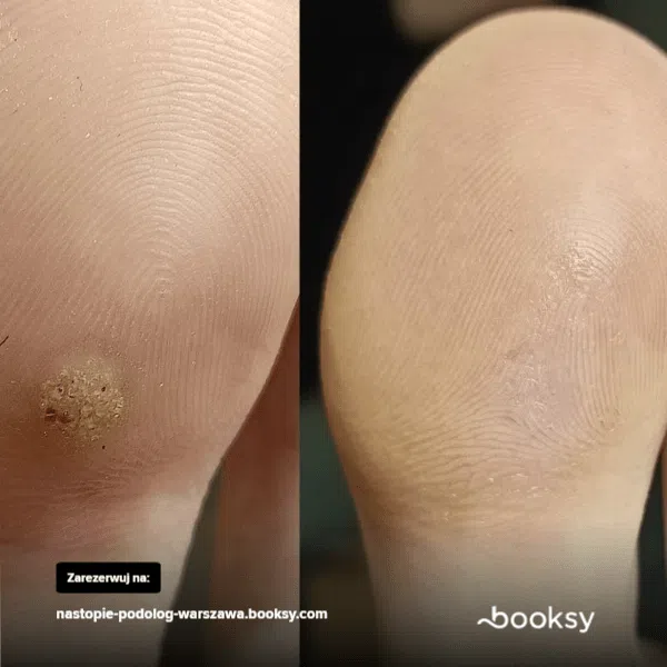 Efekty usuwanie kurzajek Warszawa przed i po