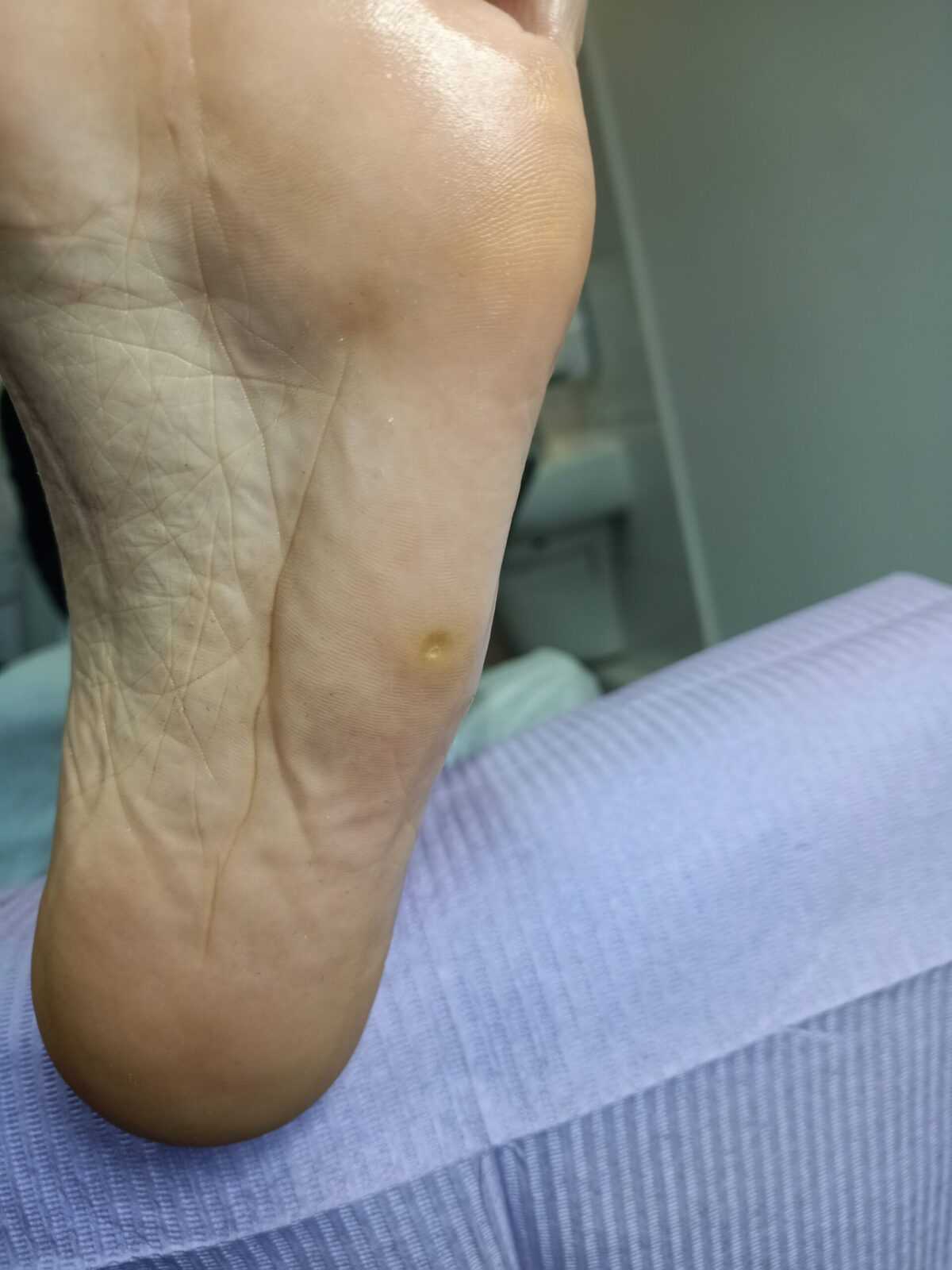 Odcisk na stopie Warszawa Bielany - zrogowacenie przed opracowaniem specjalistycznym