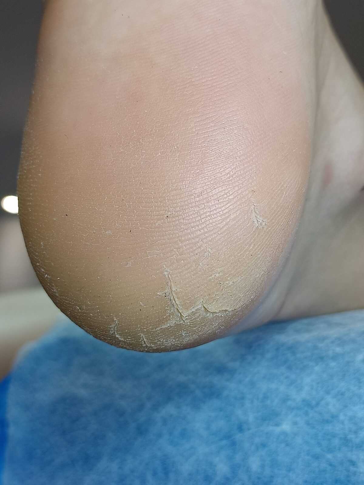 Pękające pięty Warszawa Bielany - stan przed profesjonalną pielęgnacją i wygładzaniem naskórka