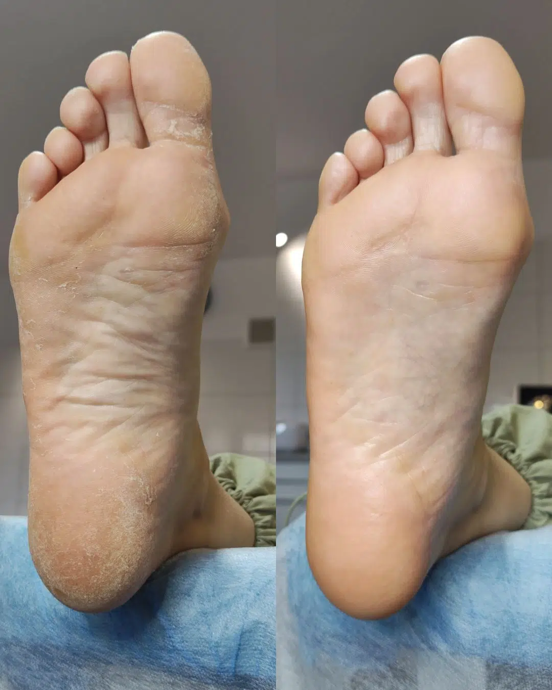 Pedicure preparatowy KART Warszawa Bielany - ekspertki podologii Justyna Liszko i Julia Kolczyńska z Gabinetu Na Stopie