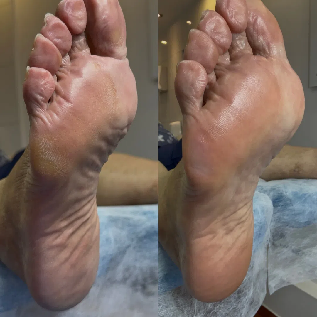 Pedicure podologiczny zaawansowany Warszawa Bielany - opracowywanie zrogowaceń sterylnymi narzędziami w Gabinecie Na Stopie